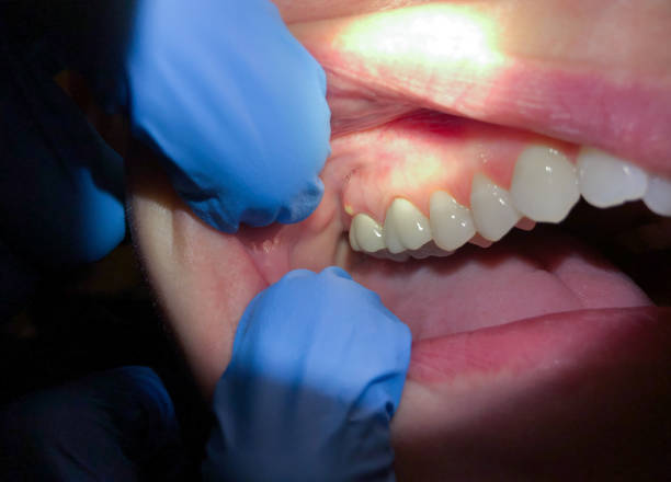 Best Emergency Dentist for Lost Fillings or Crowns in Avon, IN
