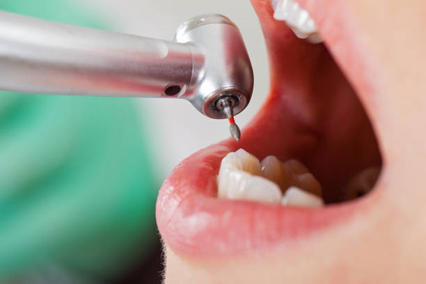 Best Emergency Dentist for Knocked-Out Tooth in Avon, IN